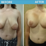 Breast Lift Mastopexy Before and After Photos - Sassan Alavi MD