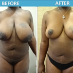 Breast Reduction Surgery - Sassan Alavi MD Before and After Photos