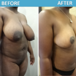 Breast Reduction Surgery - Sassan Alavi MD Before and After Photos
