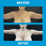 Before and after Arm lift procedure photo - front