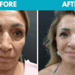 Before and after Mini face lift procedure photo - front