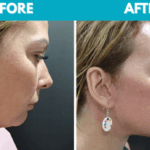 Before and after Mini face lift procedure photo - side view