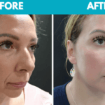 Before and after Mini face lift procedure photo - side