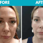 Before and after Mini face lift procedure photo - front