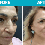 Before and after Mini face lift procedure photo - side