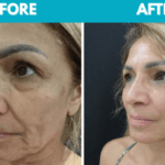 Before and after Mini face lift procedure photo - side view