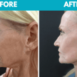 Before and after Mini face lift procedure photo - side view