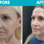 Before and after Mini face lift procedure photo - side