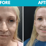 Before and after Mini face lift procedure photo - front