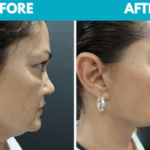 Before and after Mini face lift procedure photo - side view