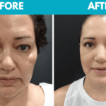 Before and after Mini face lift procedure photo - front