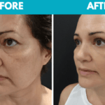 Before and after Mini face lift procedure photo - side